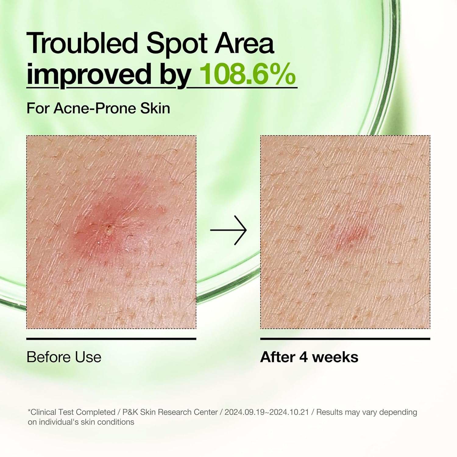 Anua Azelaic Acid 10